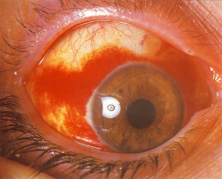imagine cu alergia oculara
